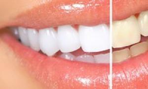 Виды отбеливания зубов – плюсы и минусы Отбеливание зубов в стоматологии виды описание