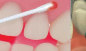 Анестезия при лечении зубов — методы обезболивания и их особенности