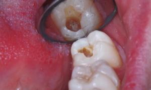 Что представляют собой зубы моляры Какие зубы относятся к малярам и премолярами
