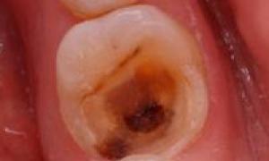 Гной в канале зуба: как лечится гнойный пульпит