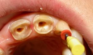 Зубной врач ортопед что делает Стоматолог ортопед что делает